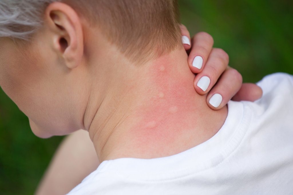 Home Remedies for Mosquito Bites